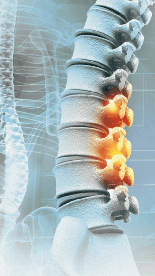 Backpain vertical (1)