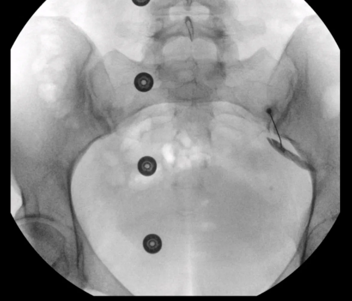 Fluoroscopic view during an image-guided piriformis injection at our office: contrast confirms needle placement within the muscle before the medication is delivered.